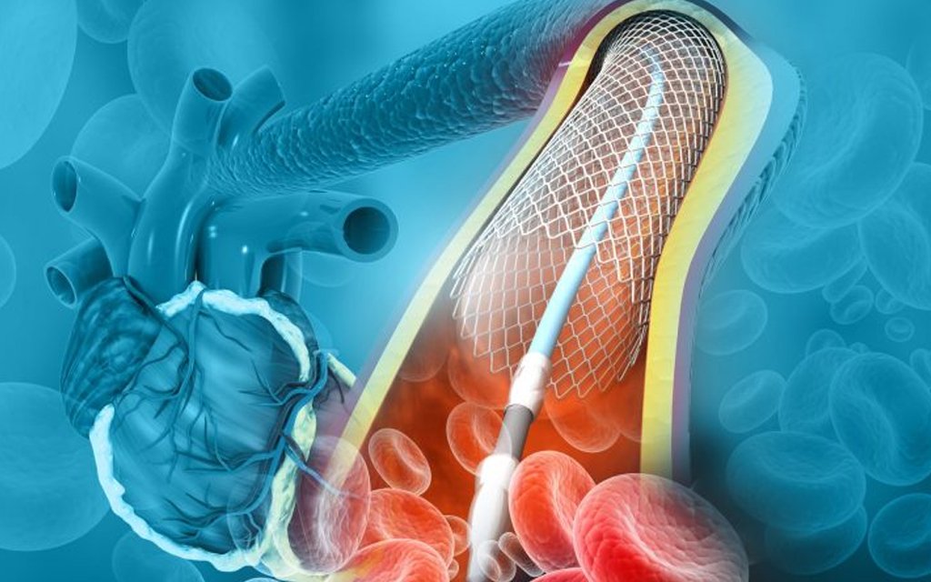 angioplasty