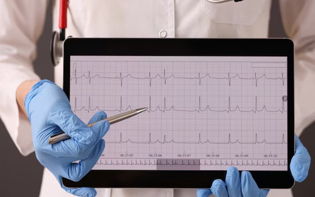 ecg