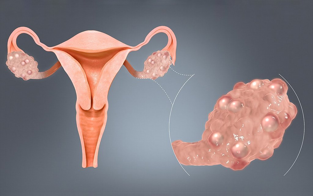 pcos